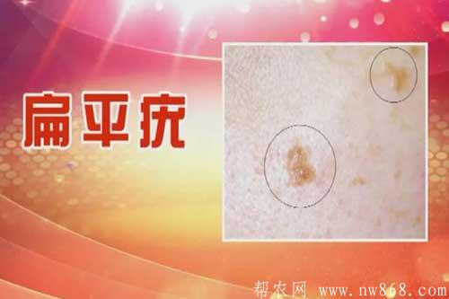 痤疮|酒糟鼻|扁平疣|寻常疣|传染性软疣|尖锐湿疣 痤疮|酒糟鼻|扁平疣|寻常疣|传染性软疣|尖锐湿疣