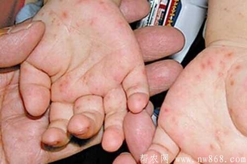 如何根据手足口病症状初期图片判断病情